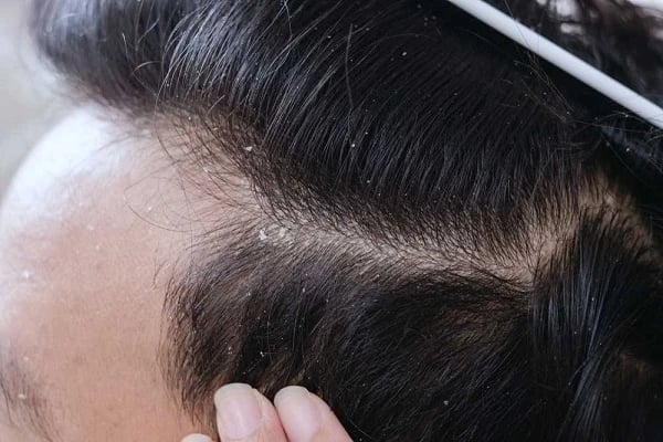 how to get rid of dandruff