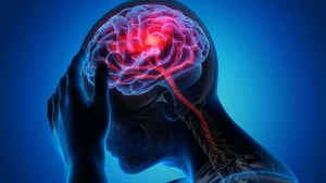 Pahami Perbedaan Sakit Kepala Biasa dan Sakit Kepala Gejala Stroke: Tanda-tanda Penting yang Harus Anda Ketahui