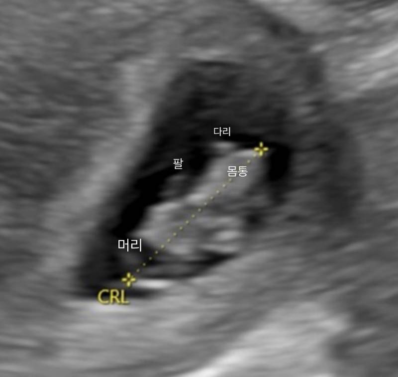 [잡담] 나 뱃속에 2센치짜리 아기있다 | 인스티즈