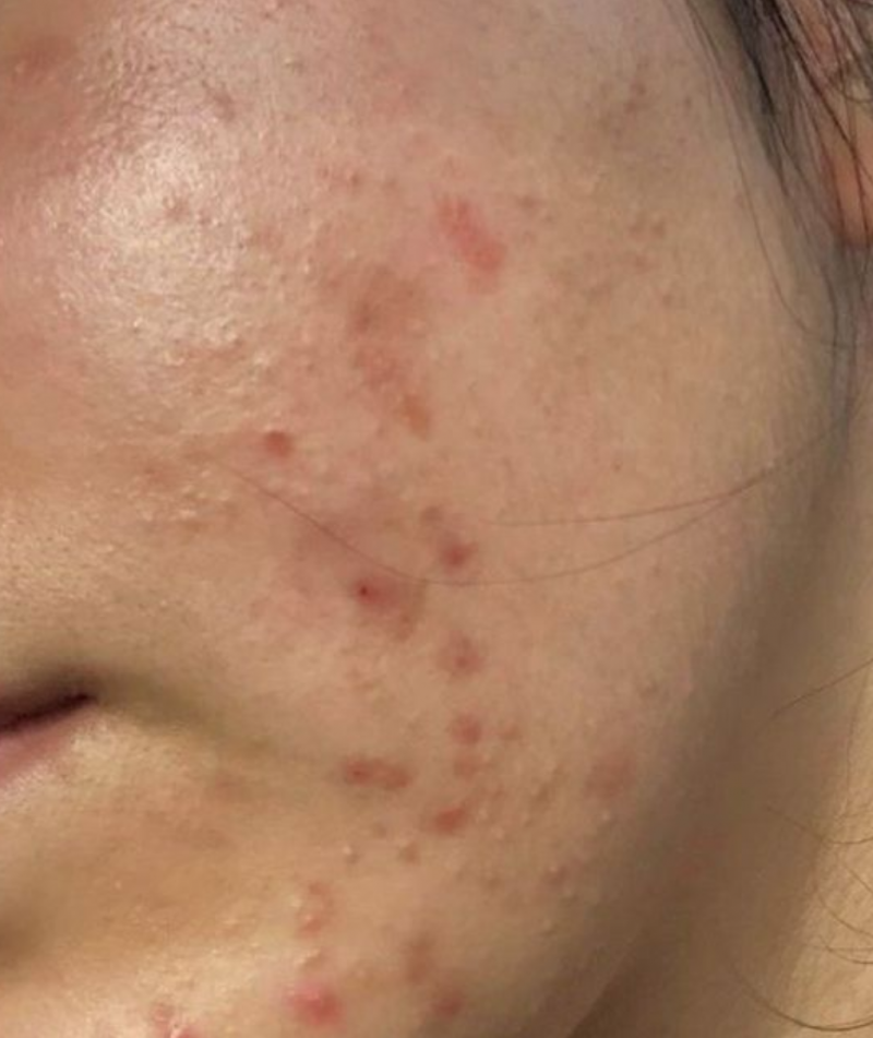 [잡담] 내 피부 한번 봐줘 ㅎㅎ1년동안 관리해서 여드름 싹 없앳다 | 인스티즈