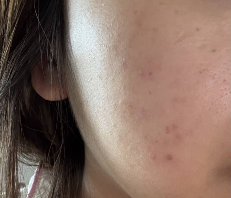 [잡담] 여드름 흉터 엑셀브이 완전 추천해 | 인스티즈