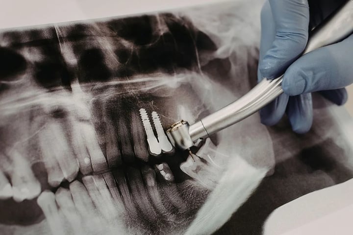 Panoramic dental image used for implant diagnosis and treatment planning