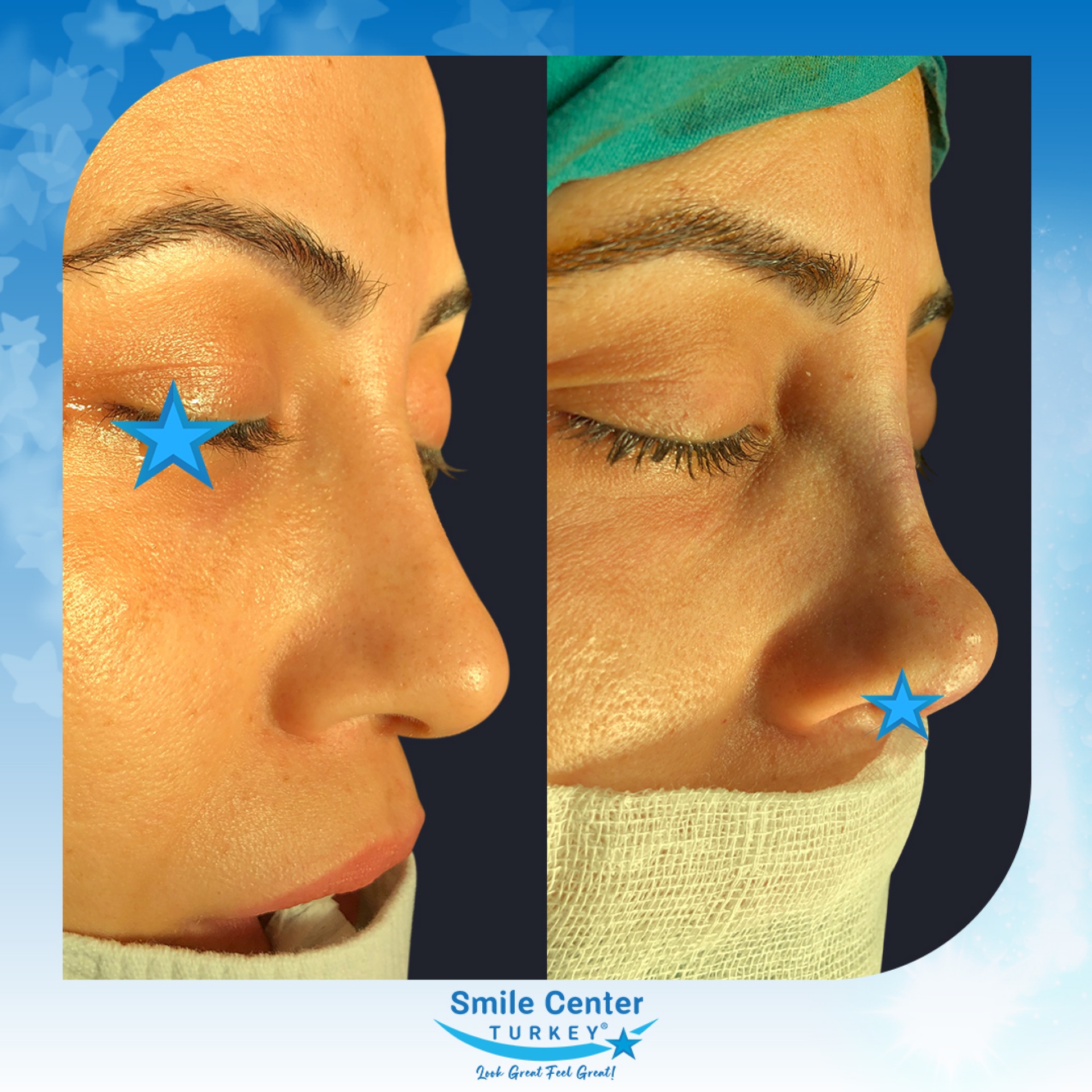 Before and after cosmetic surgery at Smile Center Turkey