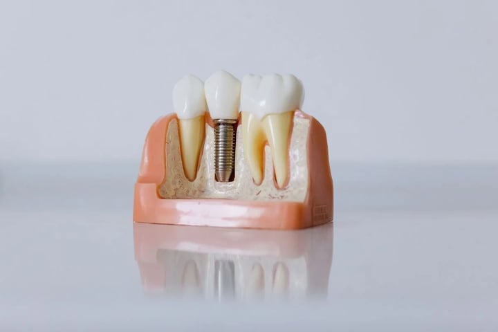 Dental model showing the relationship between implant, bone, abutment and crown