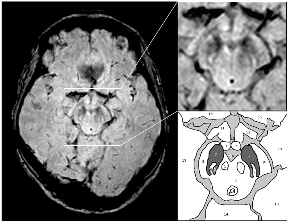 Tajemství Parkinsonovy choroby se začíná odkrývat: vědci poprvé vidí samotný spouštěč