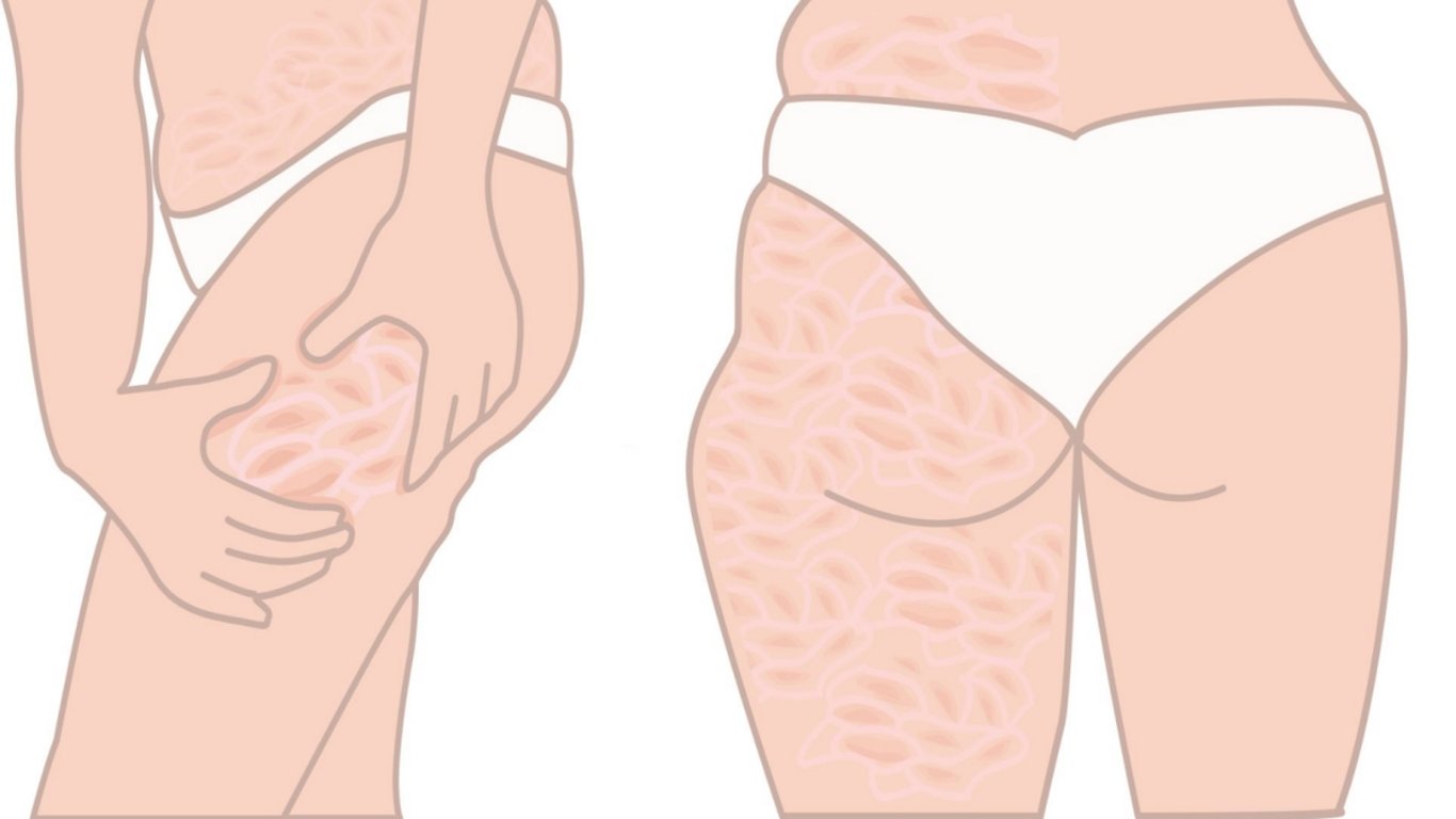 Navždy jsem se zbavila celulitidy a má pokožka se změnila k nepoznání. Netušila jsem, že to může být tak jednoduché