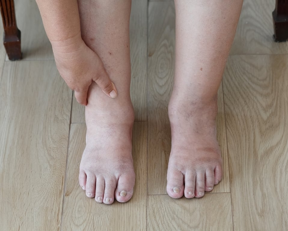 Otoky nohou mohou být prvním signálem, že něco není v pořádku. Lékaři varují, že příčina bývá skrytá a často vážná