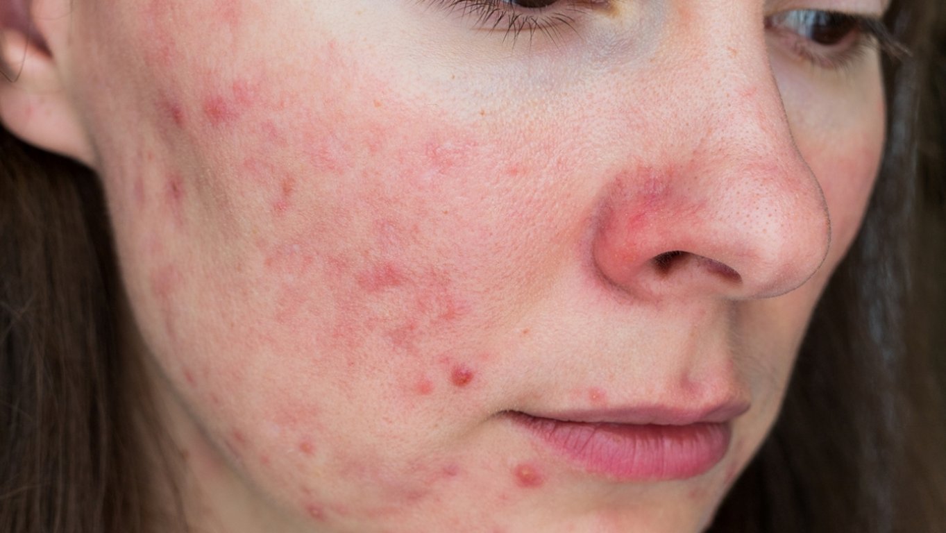 Na první pohled zdravá jídla můžou pleti brutálně škodit. Akné pak nezmizí ani po drahé kosmetice