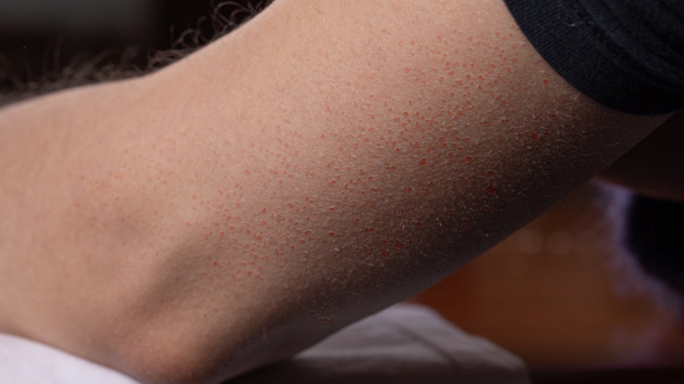 „Kuřecí kůže“