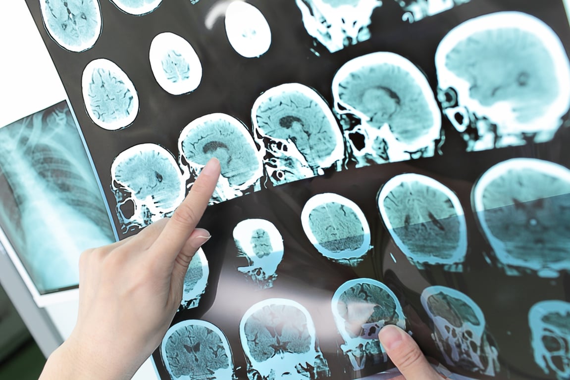 Konec Alzheimera už nemusí být jen sen. Nový lék ukázal výsledky, které mohou změnit tisíce životů