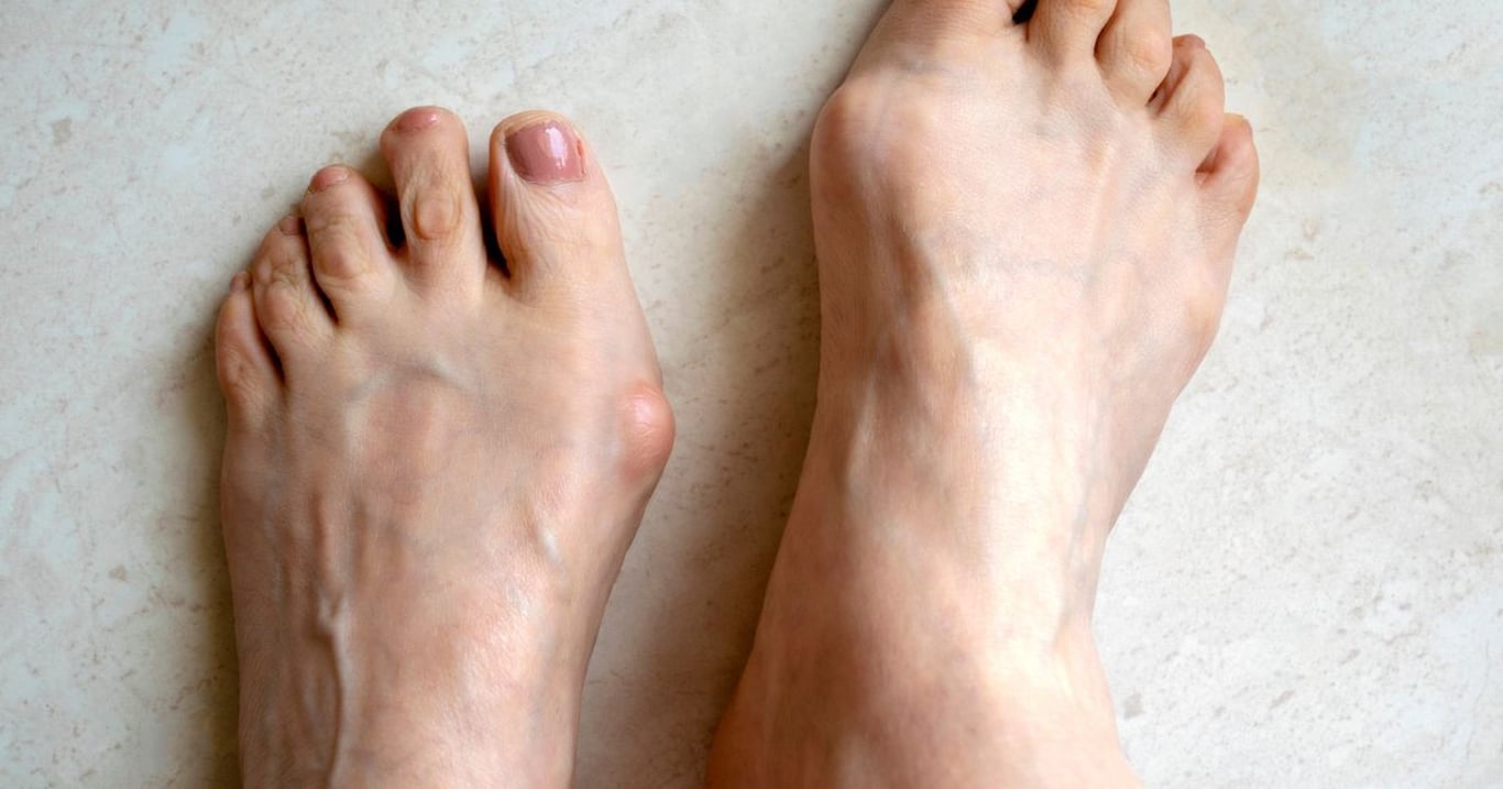 Vbočený palec už nemusí být problém. Domácí způsob přináší úlevu bez bolesti i operace