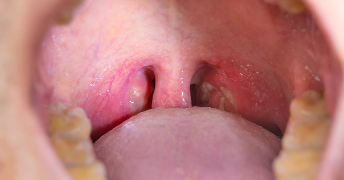 Tento příznak klame tělem a vypadá jako běžné nachlazení. Ve skutečnosti ale může znamenat začátek něčeho mnohem vážnějšího