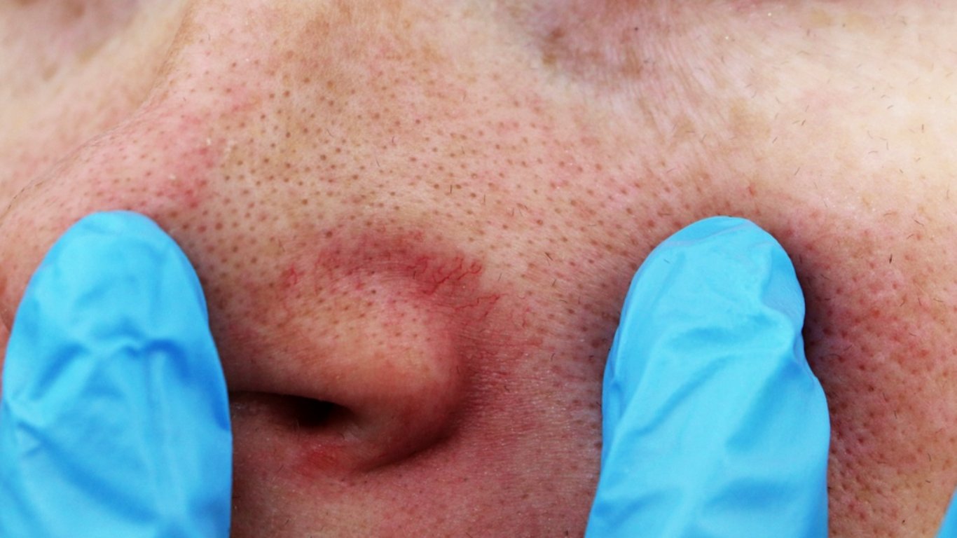 Na černé tečky už nebudete potřebovat masku ani páru. Tahle složka si s nimi poradí rychle a do hloubky