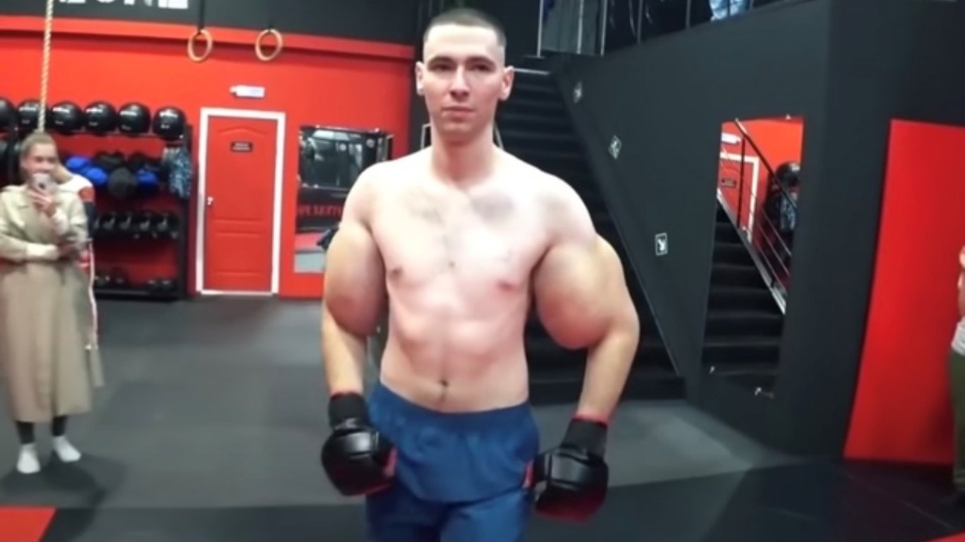 Touha po obrovských bicepsech se změnila v noční můru. Ruskému Pepkovi stále hrozí amputace, přesto nelituje