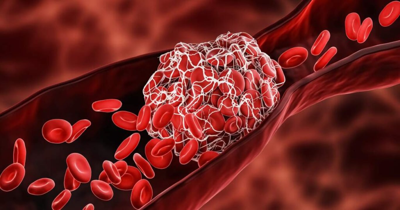 Riziko vzniku trombózy zvyšují i časté lidové zlozvyky