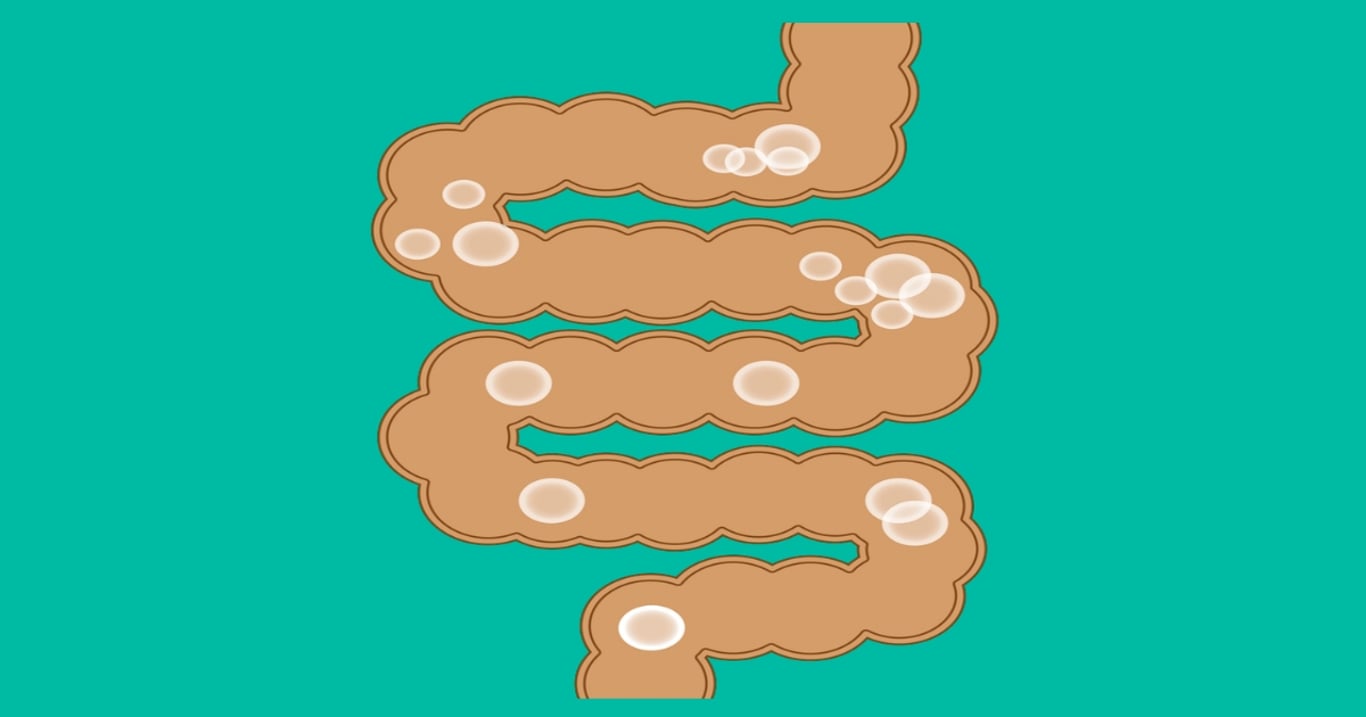 Helicobacter pylori se šíří mezi Čechy tiše a rychle. Mnozí zjistí pravdu až ve chvíli, kdy je pozdě zasáhnout