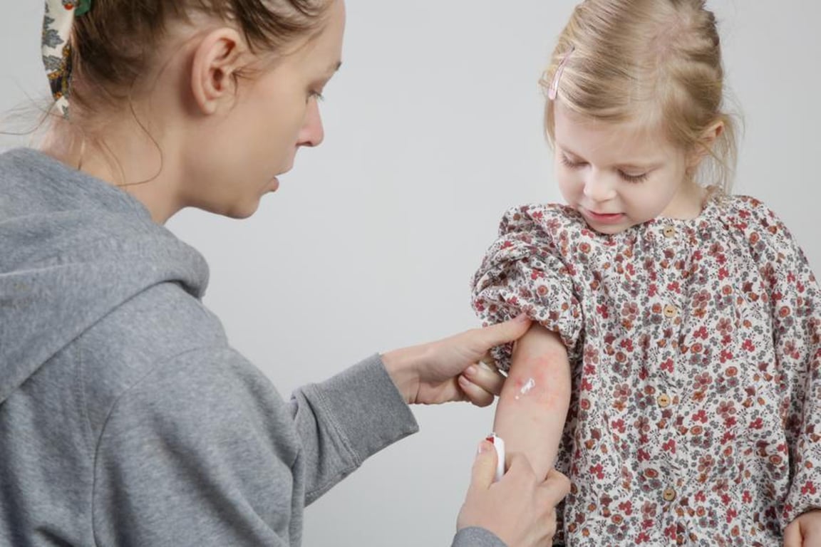 Všude tekla krev, vzpomíná maminka malé dcery s ekzémem. Každé převlékání obrečela