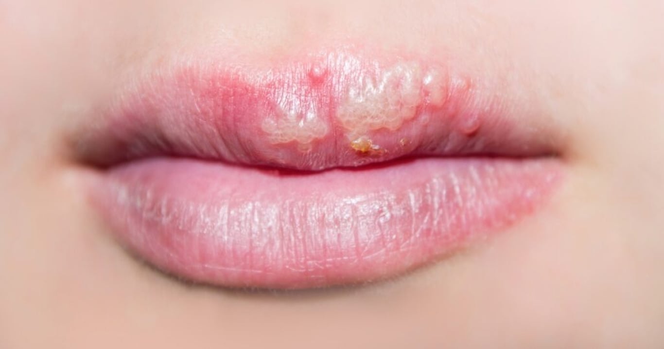 Po oparu nezbyde ani stopa: Lékařka doporučuje tento snadný trik, díky kterému zmizí do pár hodin