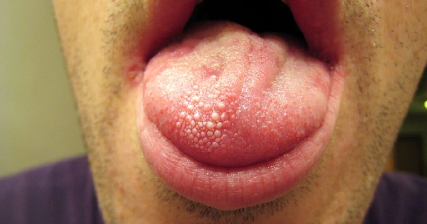 Většina lidí bere sucho v ústech na lehkou váhu. Jedná se však o předzvěst této zdravotní tragédie