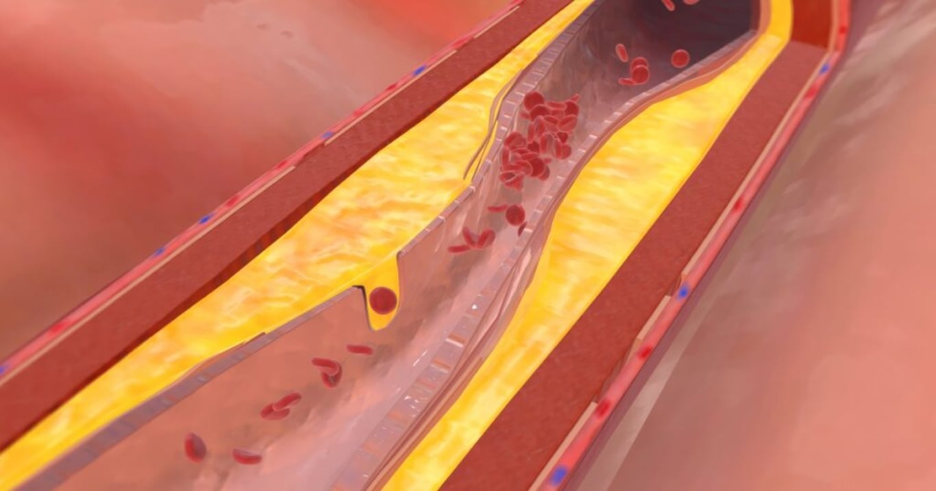 Kriticky důležité příznaky, které vám mohou včas zachránit život. Pokud si jich všimnete, máte vysokou hladinu cholesterolu
