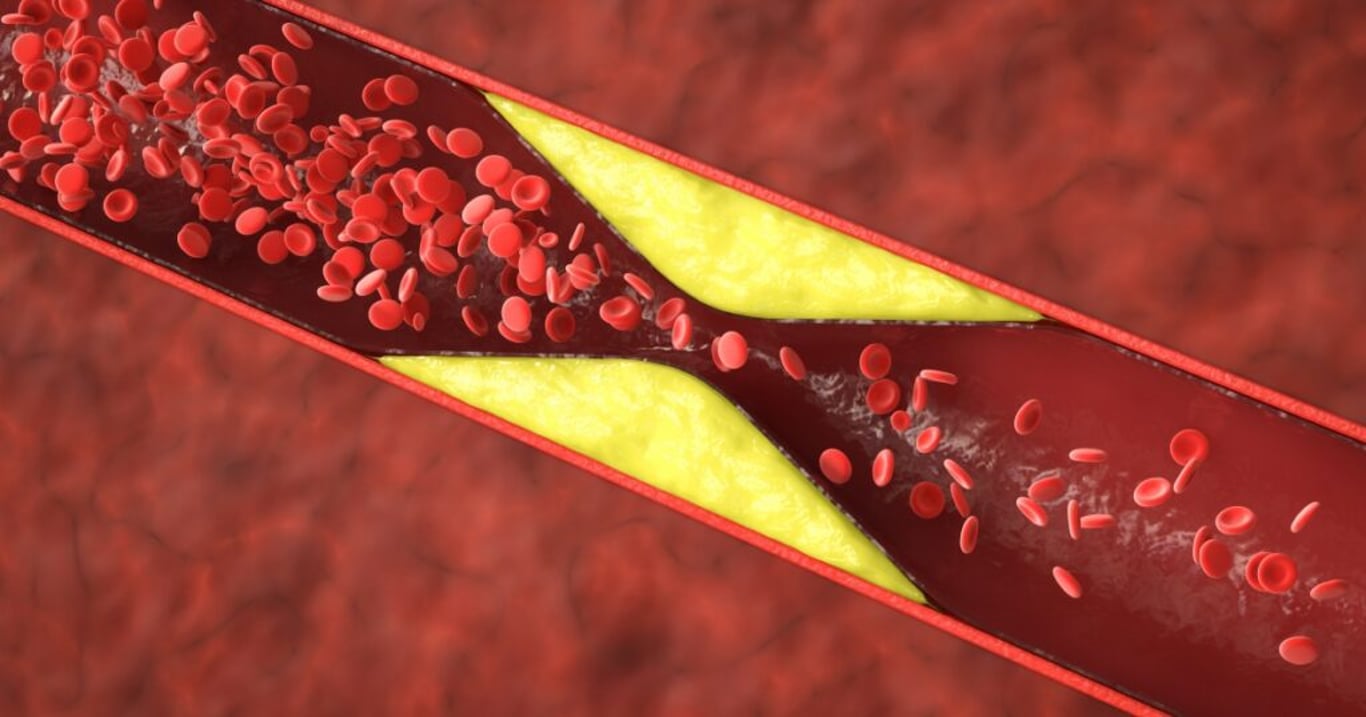 Lékaři odhalili hlavní příčinu, která stojí za vysokým cholesterolem u většiny lidí