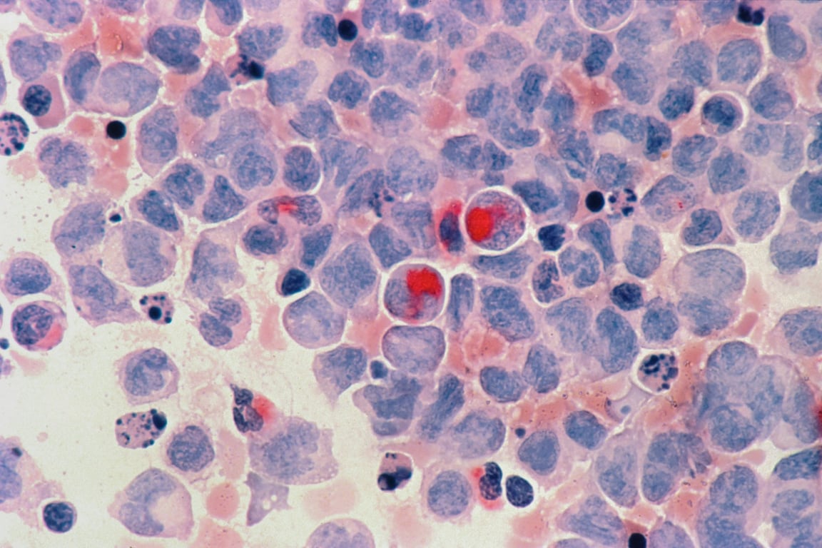 Tichý zabiják pod dohledem AI. Nový nástroj slibuje dřívější a přesnější diagnostiku