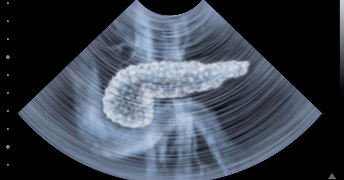 Tělo signalizuje karcinom slinivky. Tyto příznaky nepřehlížejte