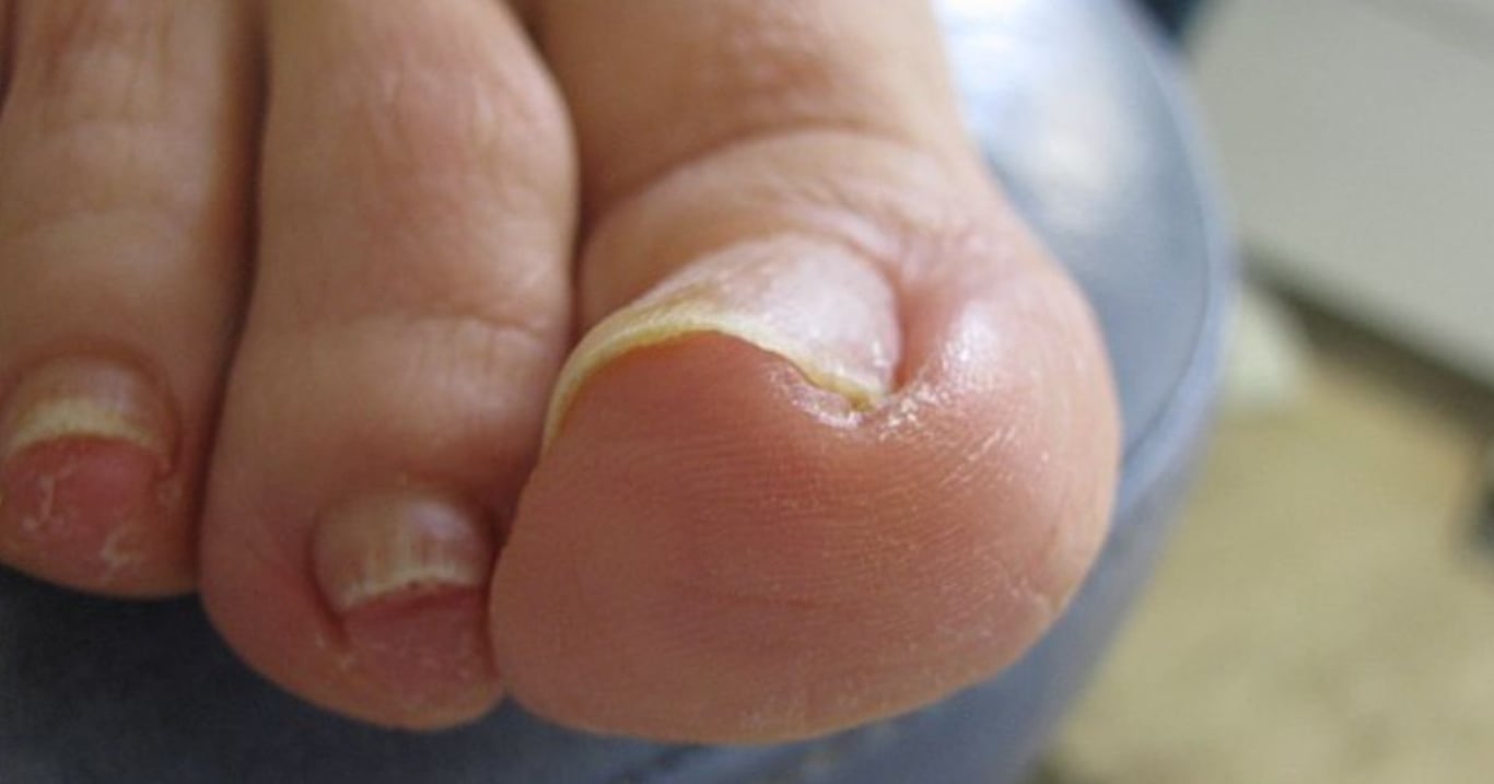 Díky radě zdravotní sestry jsem se zbavila zarostlého nehtu sama. Stačilo pár minut a bylo po problému