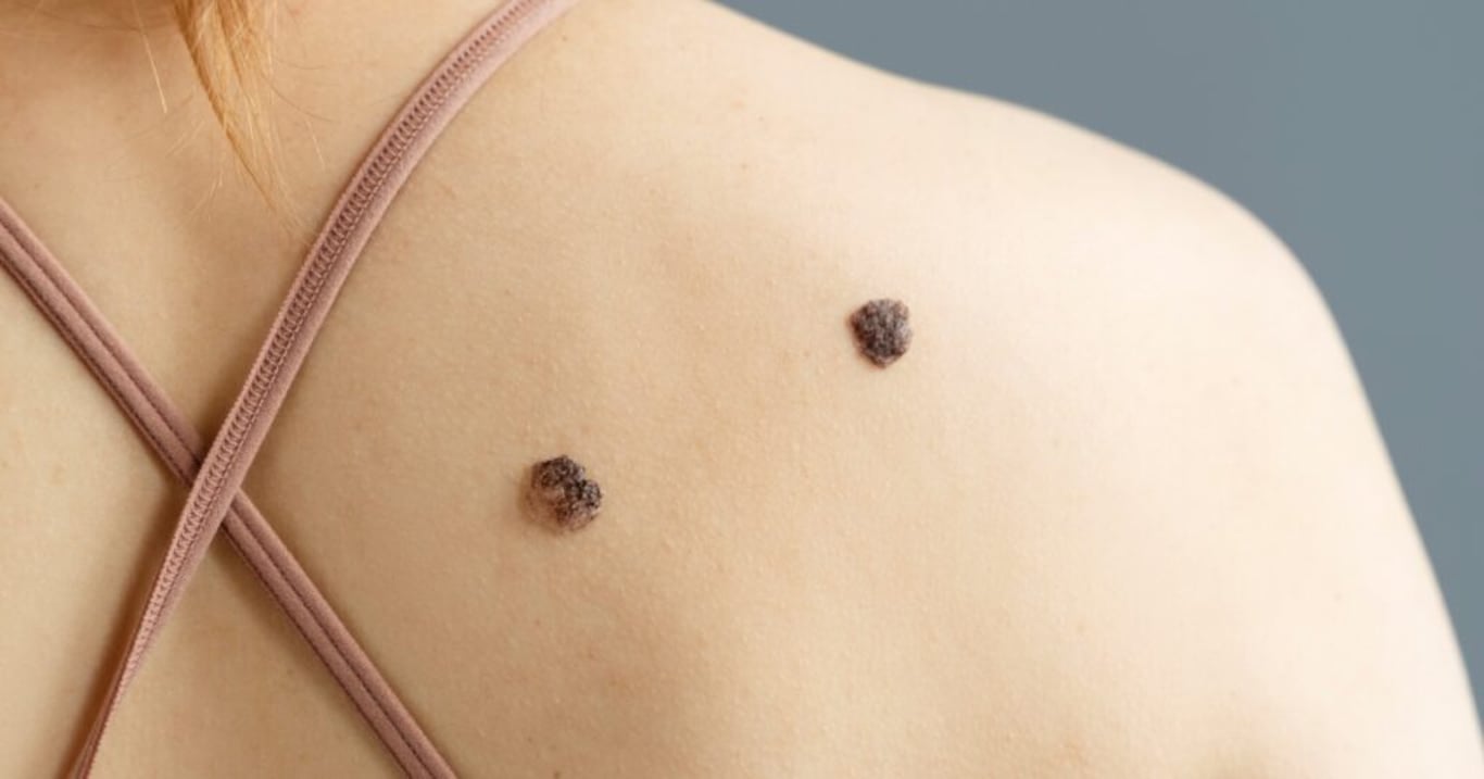 Lékařka s rakovinou odhalila příznak, díky kterému se sama mohla vyhnout drastickým následkům