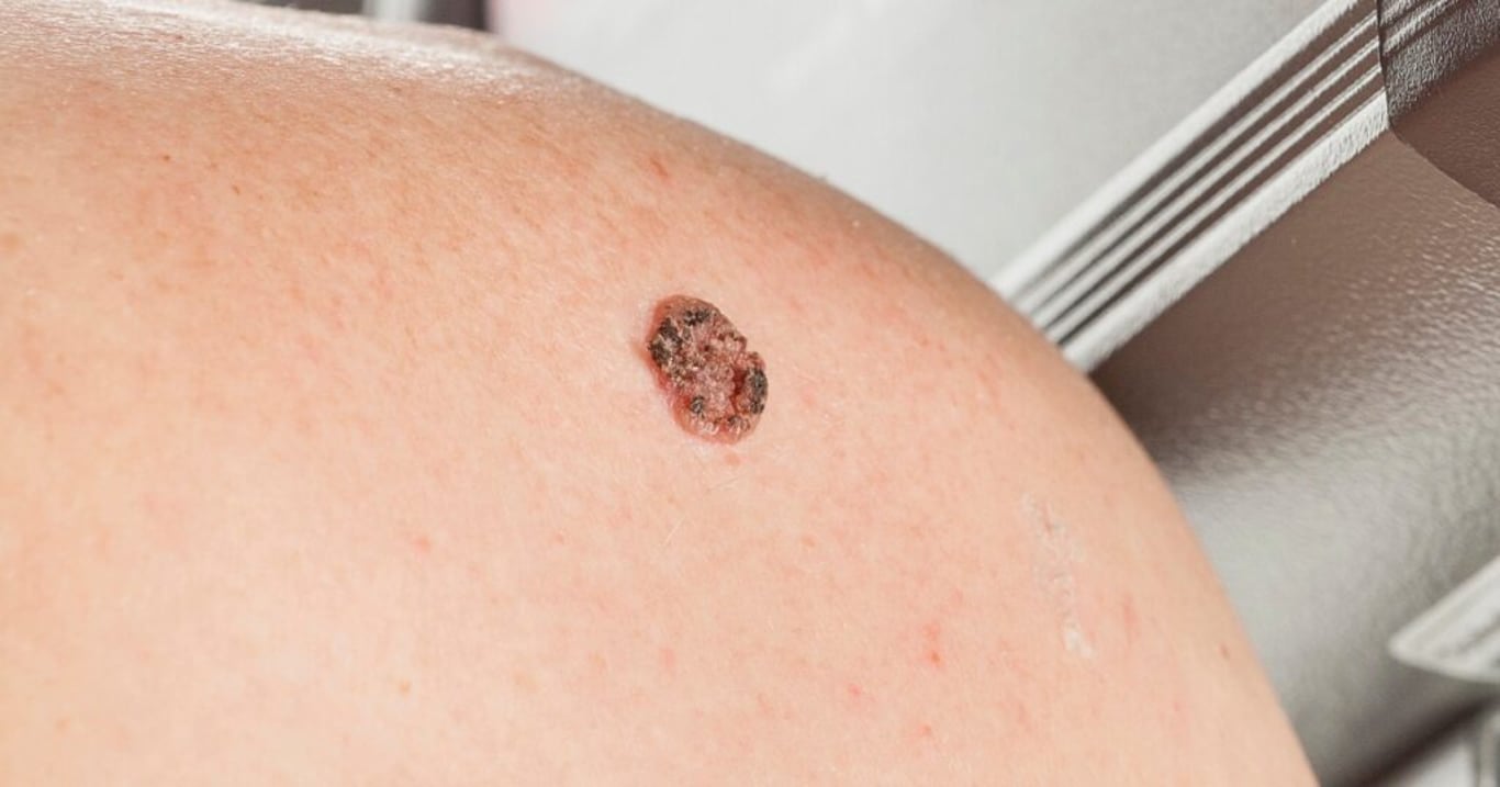 Mladá matka si všimla zdánlivě obyčejného pupínku. Že se jedná o rakovinu kůže, jí došlo až na poslední chvíli
