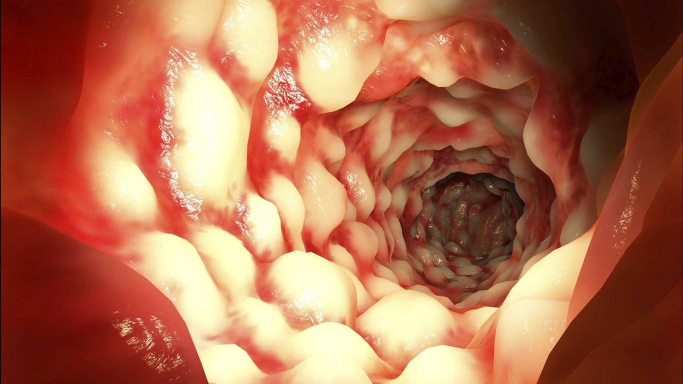 Crohnova nemoc může být nebezpečnější než infarkt. A stačí jeden nenápadný zlozvyk, který to celé odstartuje