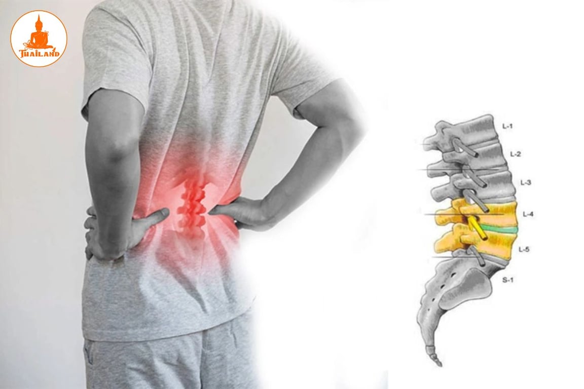 Thoát vị tiến triển nặng có thể dẫn đến liệt một phần hoặc toàn bộ chi dưới