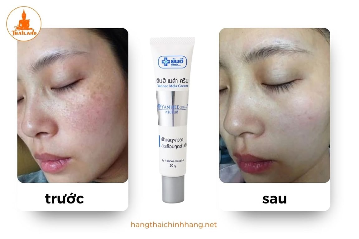 Sau một thời gian sử dụng kem trị nám Yanhee các vết nám mờ dần