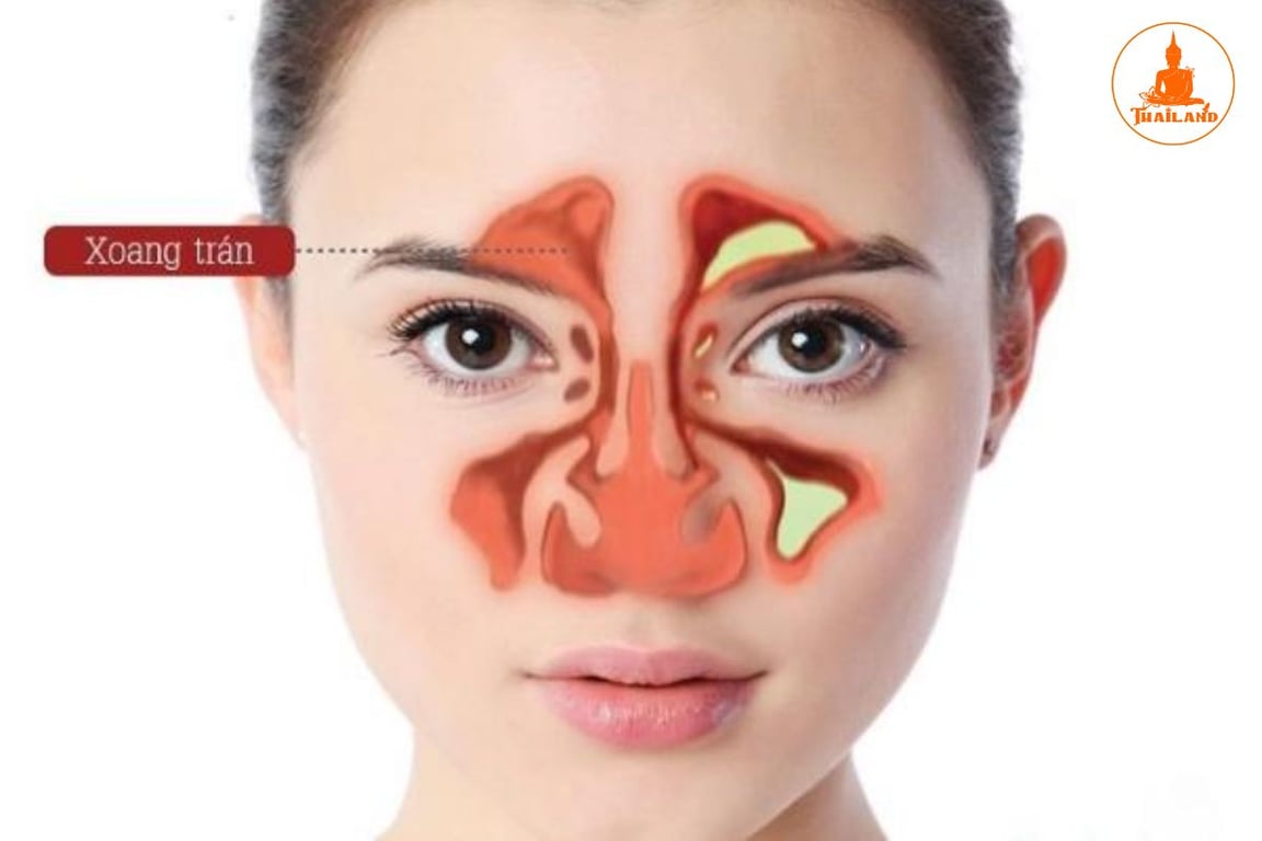 Xoang trán nằm trong phần xương trán và được xem là xoang có vị trí cao nhất trong số các xoang vùng mặt
