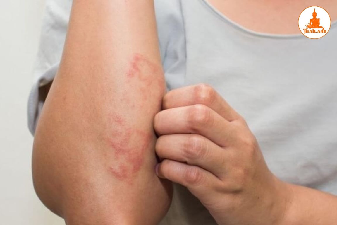 Người bị ngứa gãi nổi cục là do bệnh chàm da