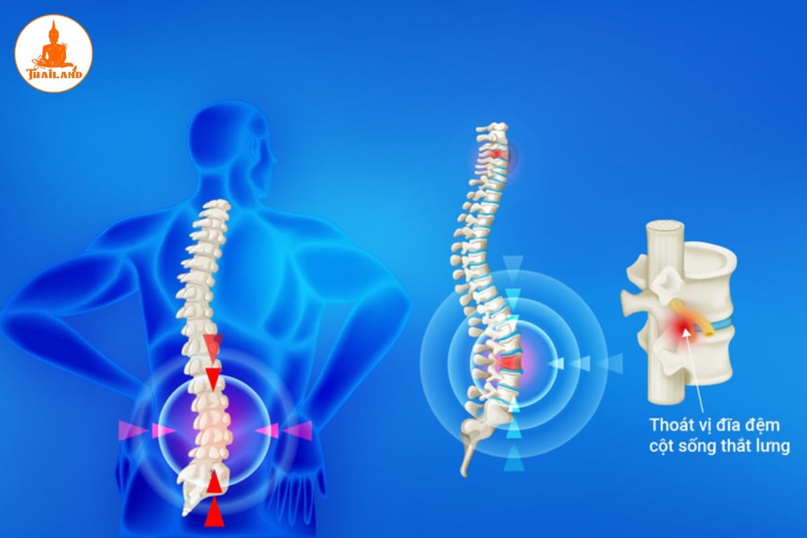 Thoát vị đĩa đệm L4, L5 do thói quen ngồi hoặc đứng yên một chỗ trong thời gian dài