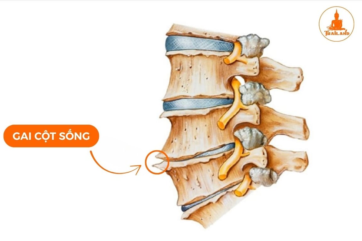 Gai cột sống là bệnh xương khớp thường gặp ở người lớn tuổi