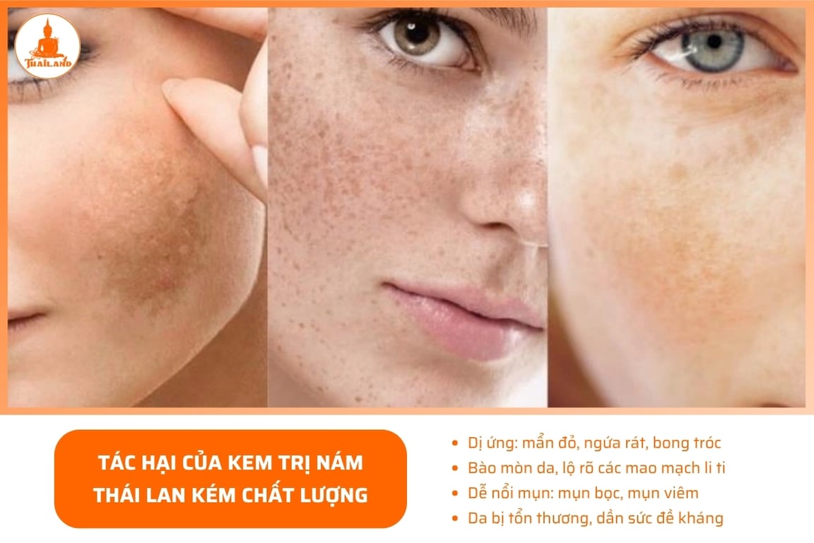 kem trị nám Thái Lan kém chất lượng có thể gây bào mòn da