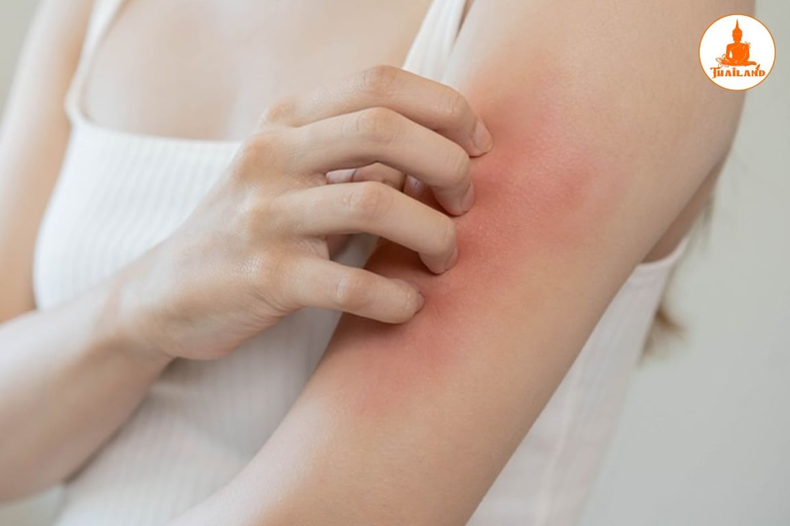 Thuốc trị dị ứng mẩn ngứa hạn chế sự sản sinh histamin – nguyên nhân chính gây ngứa ngáy