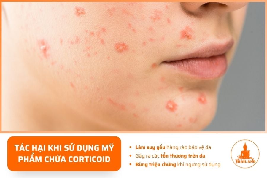 Việc sử dụng mỹ phẩm chứa corticoid khiến bề mặt da bị bào mòn