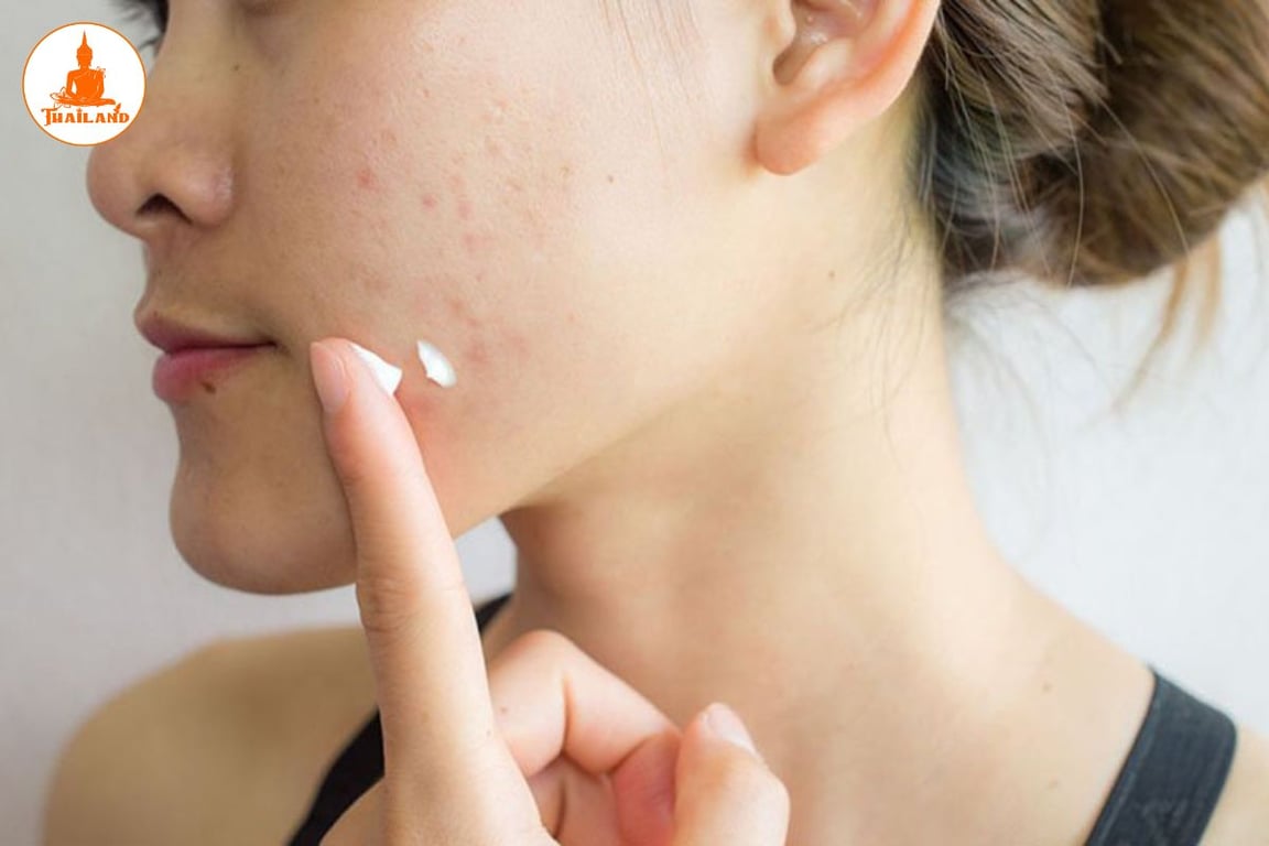 Sử dụng kem trị mụn Thái Lan 1–2 lần mỗi ngày, ưu tiên vào buổi tối