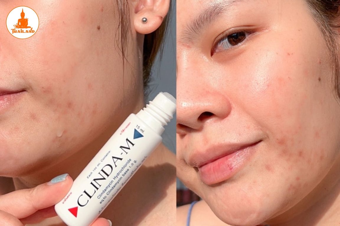 Clinda-M giúp giảm nhanh tình trạng mụn viêm, mụn bọc