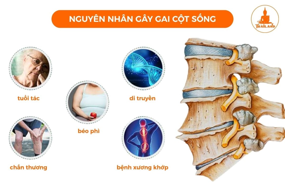 Lão hoá là nguyên nhân phổ biến gây gai cột sống