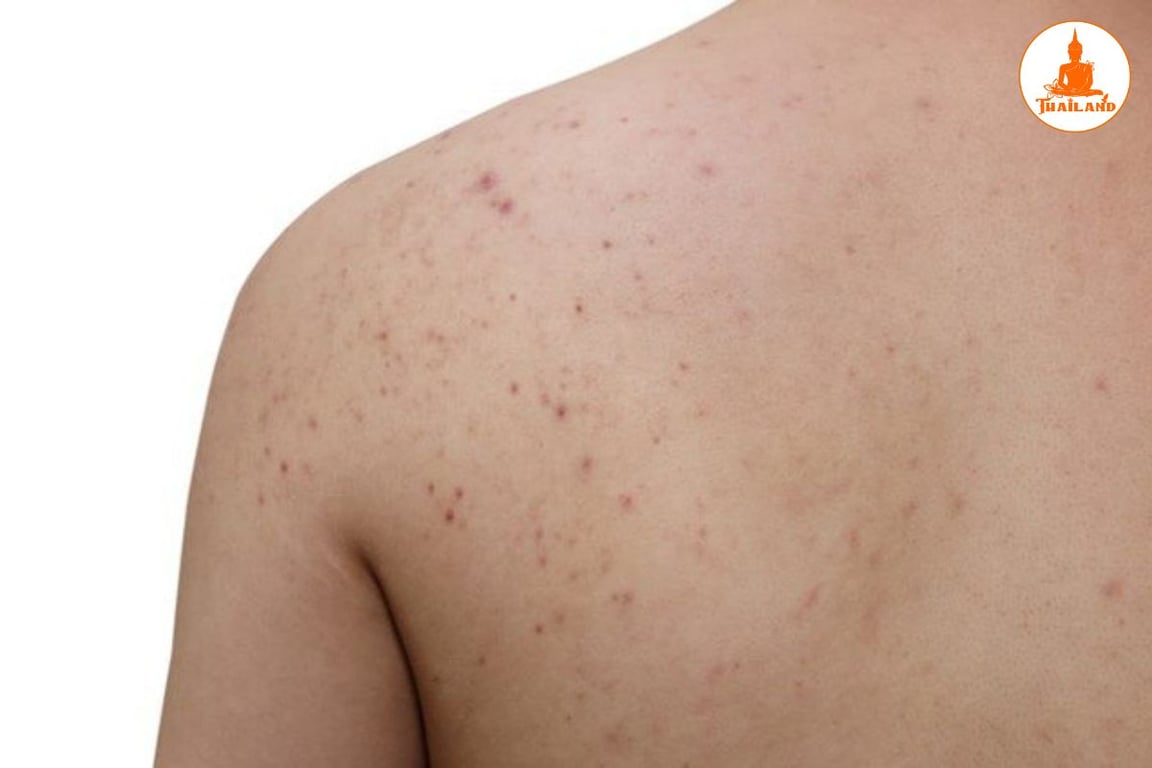 Ngứa do gan thường râm ran và xuất hiện ở các vị trí như tay, chân, mặt, lưng,...