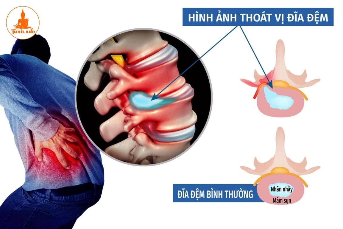 thoát vị đĩa đệm L4, L5 là tình trạng xảy ra ở hai đốt sống cuối của vùng thắt lưng