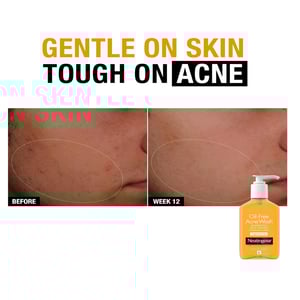 Neutrogena Oil Free Acne Wash 269ml •