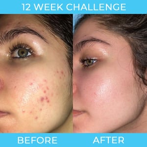 Differin Adapalene Gel 0.1% Acne Treatment 15g .