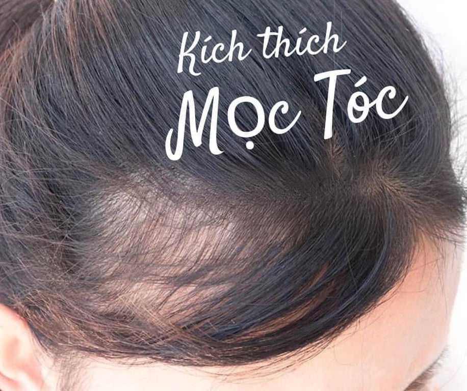 𝗧𝗛𝗨𝗢̂́𝗖 đặc trị  𝗠𝗢̣𝗖 𝗧𝗢́𝗖, Đ𝗔̣̆𝗖 𝗧𝗥𝗜̣ 𝗛𝗢́𝗜 , 𝗥𝗨̣𝗡𝗚 𝗧𝗢́𝗖 𝗠𝗜𝗡𝗢𝗫𝗜𝗗𝗜𝗟  5% BAILLEUL của Pharmacie Pháp