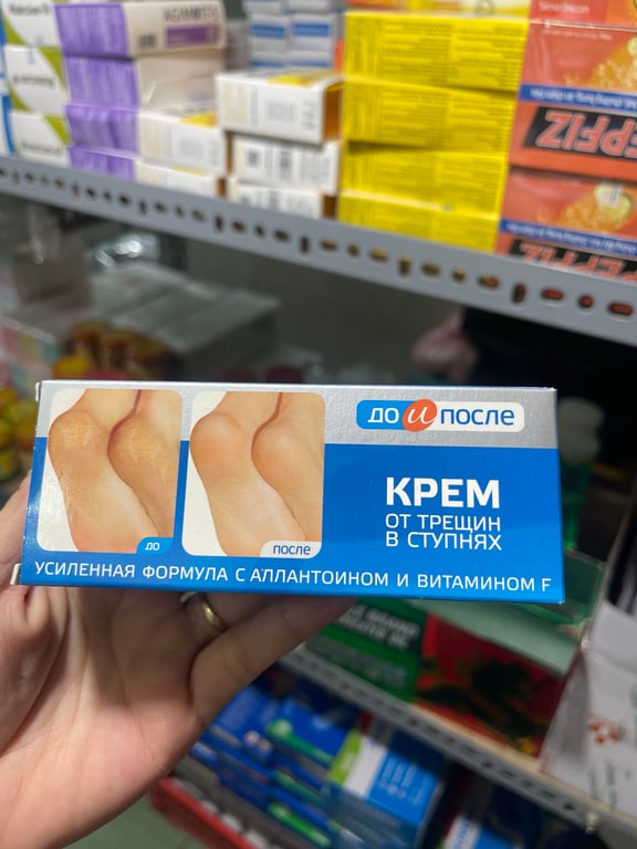 Nứt gót chân nga