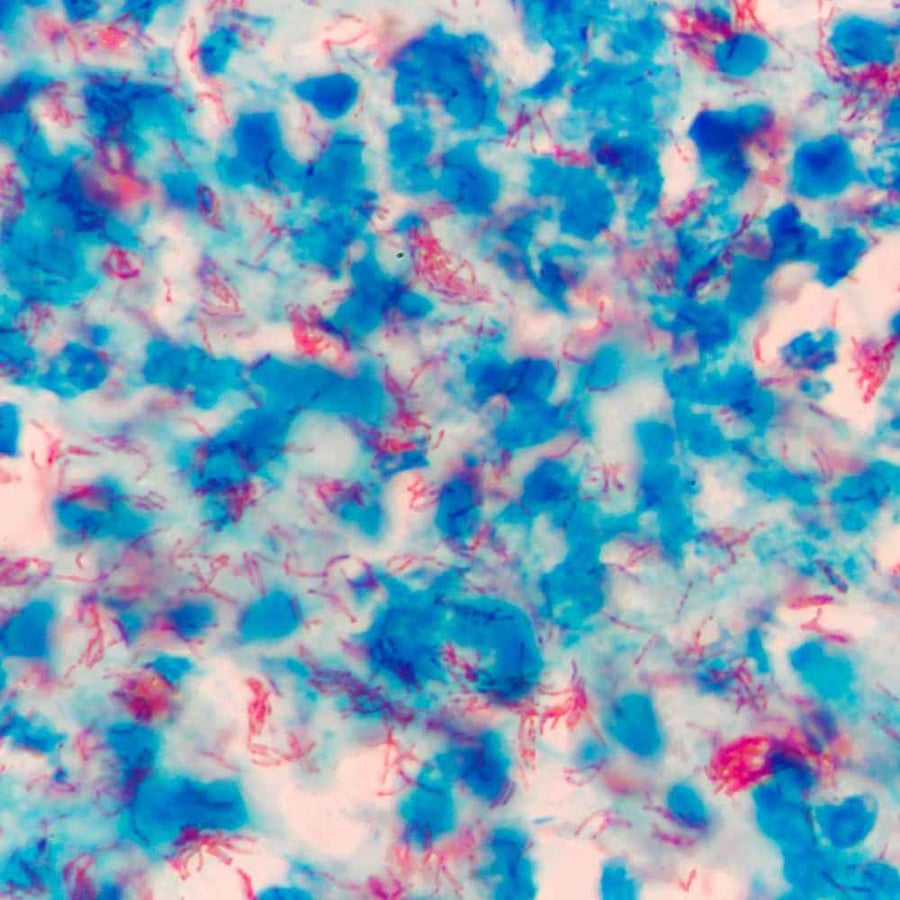 World Tuberculosis Day